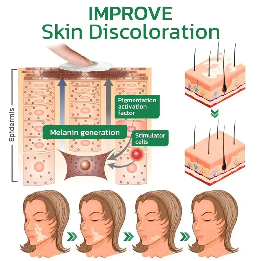Natural TreatVitiligo Soothing Cream Skin Care Improve Skin Discoloration Vitiligo Care Cream Moisturizes Fast Penetration