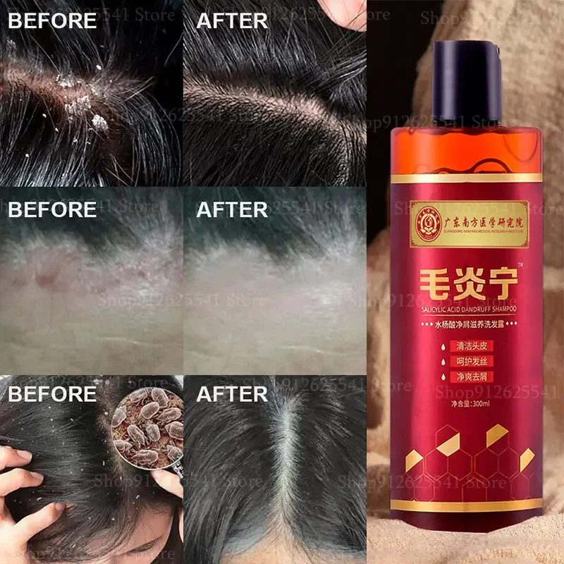 300ML Remove Dandruff Control Itching Antipruritic Shampoo Chinese Herbal Anti-Dandruff Anti-Itch Shampoo Oil-control Refreshing