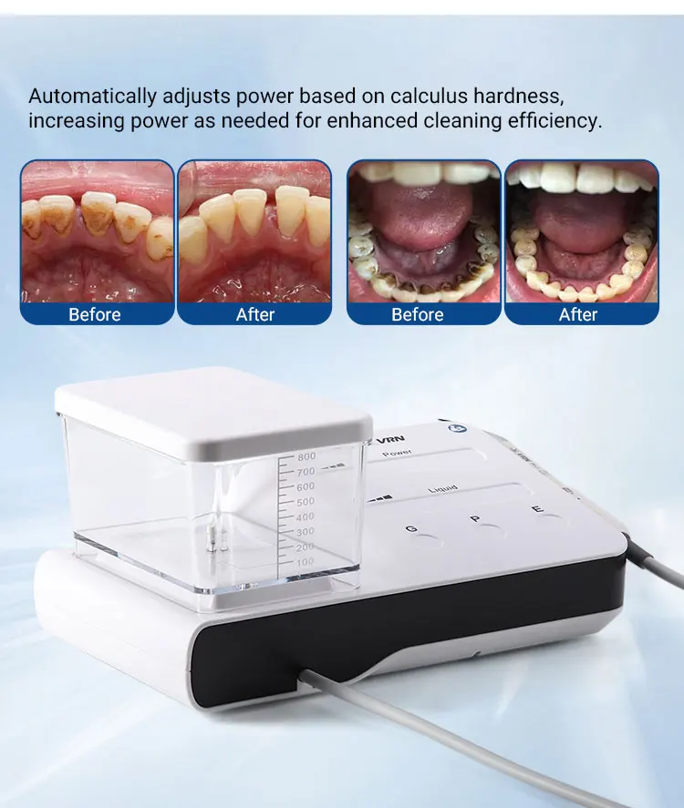 AZDENT Dentaler Ultraschall-Scaler DA20 für Zahnsteinentfernung, Parodontal- und Endodontie-Behandlungen, Wurzelkanalbehandlung, Piezo-LED, abnehmbares Handstück – Detail 5