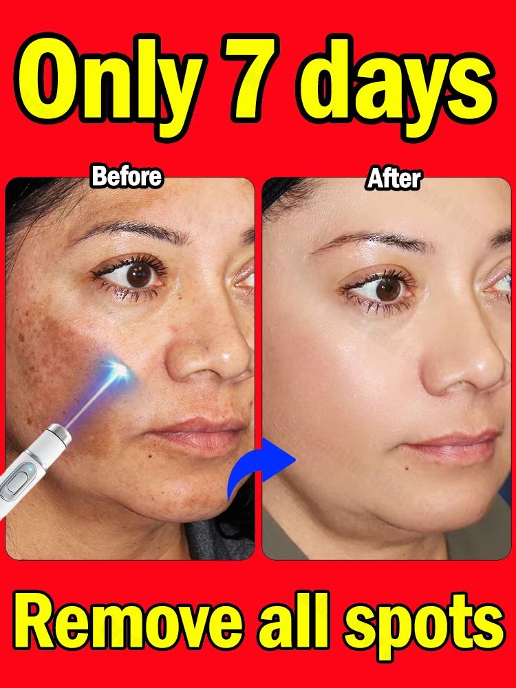 

Anti-freckle essence, effectively removes dark spots, age spots, chloasma and freckles in 7 days