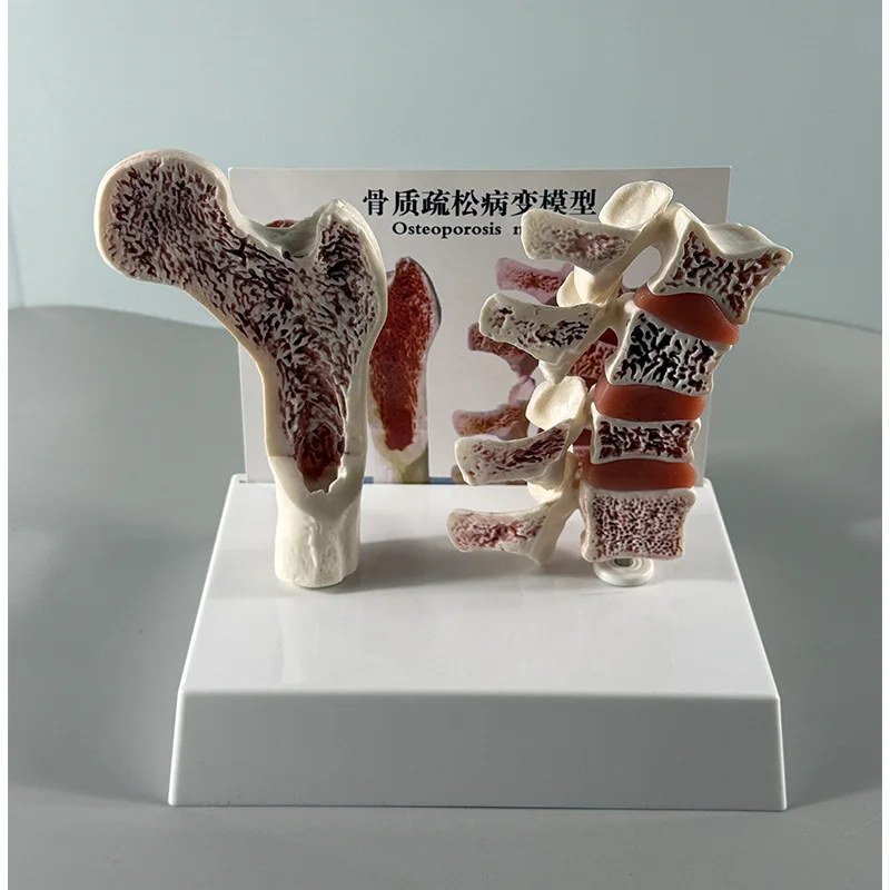 

Анатомическая модель остеопороза человека, обучающий реквизит, анатомический дисплей скелетных позвонков для домашнего класса