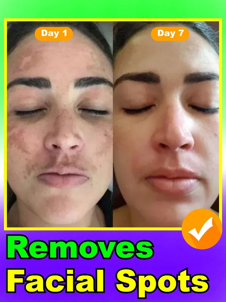 

100% solve facial dark spots and melasma, effectively eliminate pigmentation problems