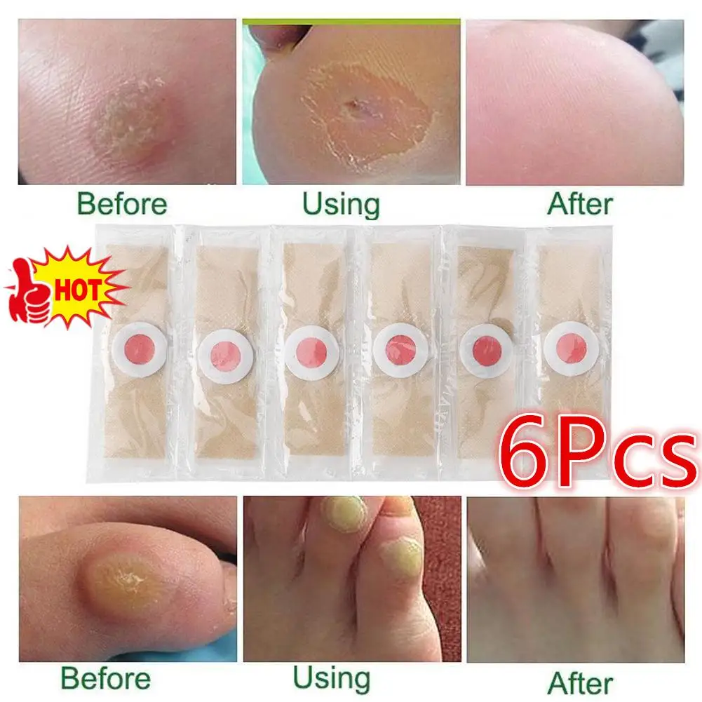 6PCS Corn Patch Corn Plaster Remover Corn Toe Pads Patch Adhesive Callus Cushion Non-woven Fabric Toe Corn Callus Removal