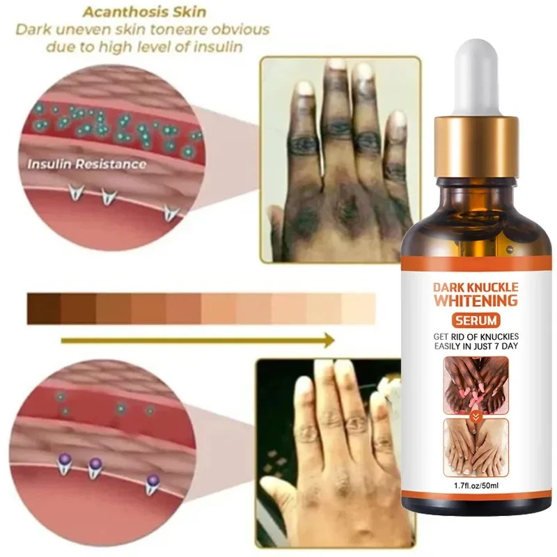 Donkere Knokkels Snel Helderen Serum Vrouwen Hand Knokkel Verlichting Melanine Essentie Ellebogen Knie Vervagen Product Verheldering Zorg