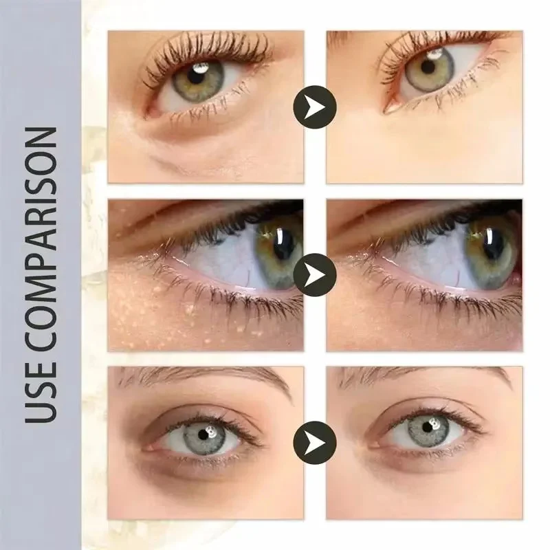 Fat Granules Remover Eye Cream Anti-Puffiness Anti Inflammatory Reduce Dark Circles Eyebags Fade Lines Moisturizing Eye Care view 2