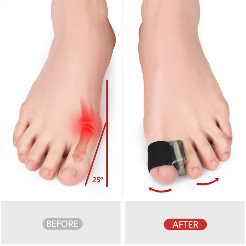 1 Paar Teen Separator Inlegzolen Ringscheiding Hallux Valgus Correctie Pad Voetverzorging Orthopedische Voet Teen Hallux Valgus Correct