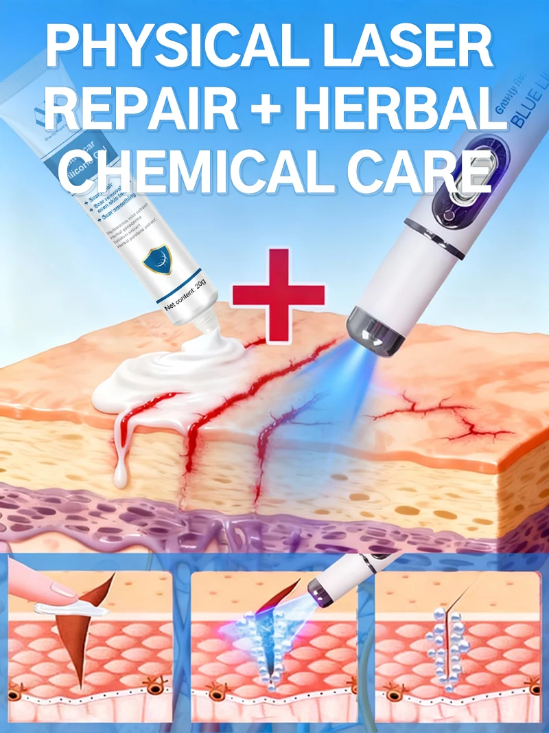 قلم الضوء الأزرق الجديد لعام 2026 لحل علامات تمدد الجسم وأدوات العناية بالبشرة أثناء الحمل