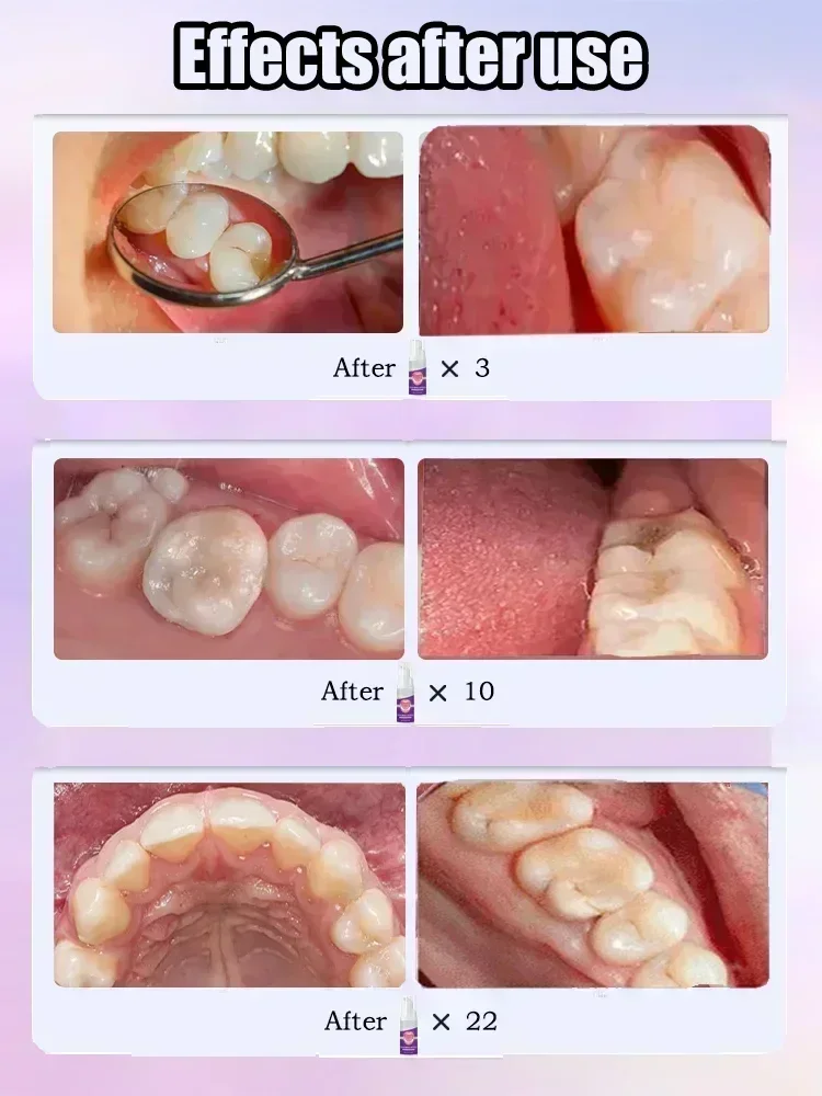 2495  Quick Repair of Cavities Caries Removal of Plaque Stains Decay Whitening Yellowing Repair Teeth Teeth Whitening