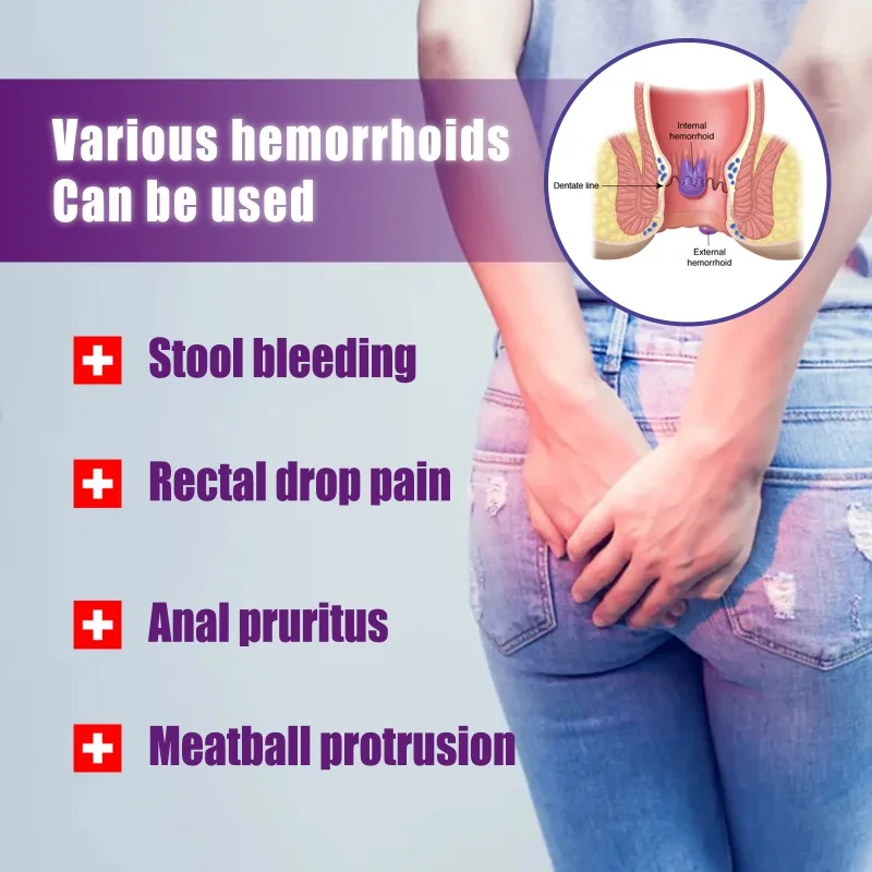 Hemorrhoids Removal Internal External Mixed Hemorrhoid Pain Treatment Herbal Spray Anal Fissure Chinese Medicine