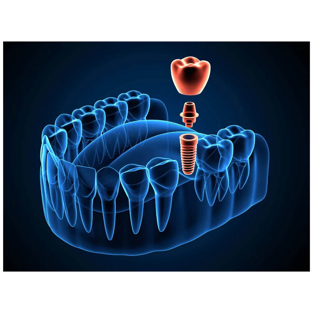 Tooth implantation Clinic Dental Dentist Wall Art Print Picture Posters Canvas Paintings for Living Room Decorations Home Decor