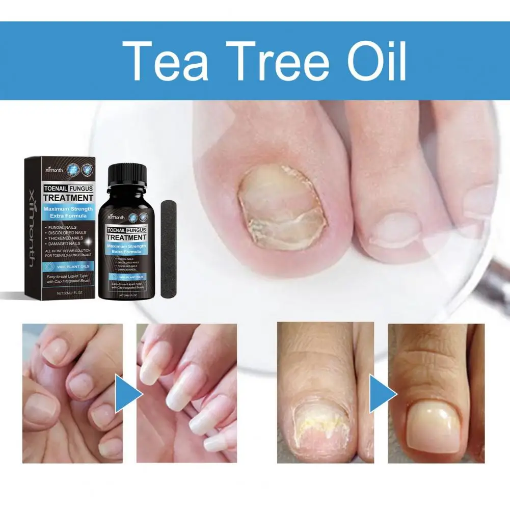 Tea Tree Oil Jojoba Oil Nail Treatment Natural Extra Strength Nail Fungus Treatment Solution for Healthy Toenail Fingernails