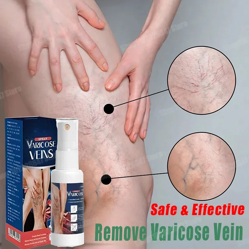 

Rapid Varicose Vein Spray Natural Herb Veins Soothing Essential Oil Spray Vasculitis Phlebitis Spider Vein Earthworm Leg Cure