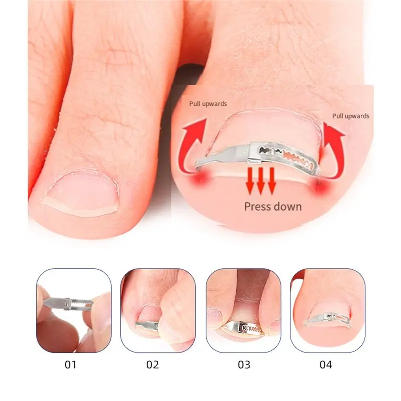 B02C-Ingrown Toenail Corrector Tools Ingrown Toenail Treatment Tools Foot Care Tools Orthopedic Nail Curler