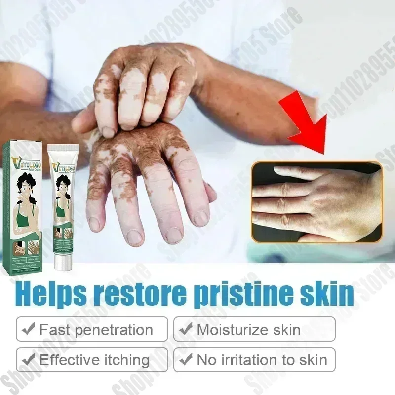 Sdotter-puntos blancos para Vitiligo, manchas blancas, Leukoplakia, pigmentación, melanina, promueve el cuidado de la piel del Vitiligo, novedad, superventas, 0903