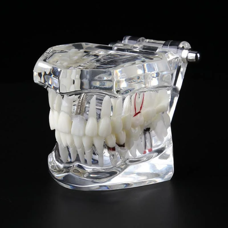 

Implant Dental Disease Teeth Model With Restoration Bridge Tooth Dentist For Medical Science Dental Disease Teaching Study Tool
