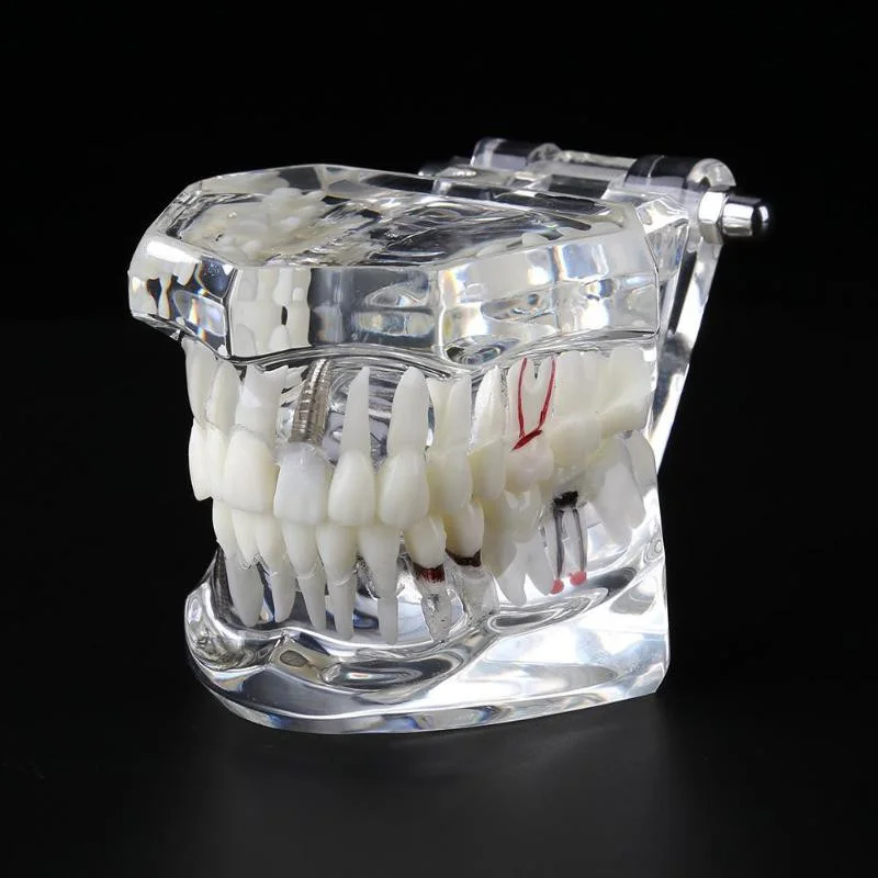 Implant Dental Disease Teeth Model With Restoration Bridge Tooth Dentist For Medical Science Dental Disease Teaching Study Tool