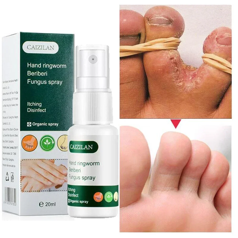 Foot Repair Spray Inhibit Fungi Infections Hand Tinea Toe Treatment El for Cracked Heel Peeling Blister Repairing Feet 족저근막염