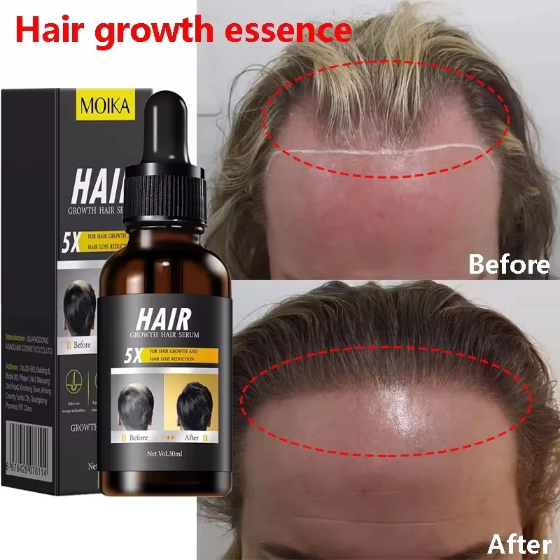 Fast Hair Growth Serum Hair Regrowth Essential Oil Anti Hair loss Repair Damaged Scalp Women Men Anti Baldness Hair Growth Care