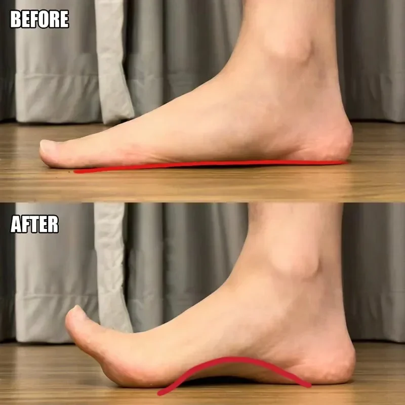 2PCS Arch Support Orthopedic Insole สําหรับเดิน Arch Half Pad X/O ประเภทขา Self-Adhesive สายคล้องสวมใส่รองเท้าส้น