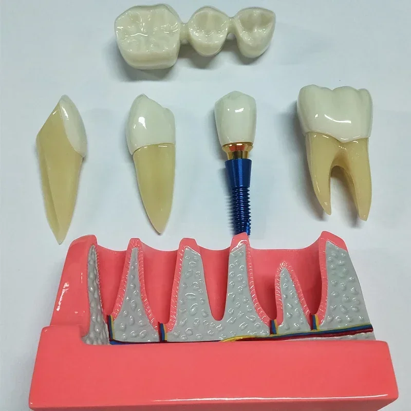 جديد زراعة الأسنان تعليم تاج جسر للإزالة نموذج الخزف نموذج لشكل الأسنان نموذج مظاهرة الأسنان لتدريس طبيب الأسنان دنت #3