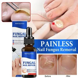 Nail Fungus Treatment Fungal Treatment Feet Care Essence Anti Infection Paronychia Onychomycosis Ingrown Toenail