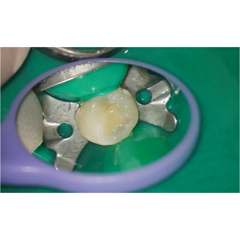 Oral Use Examination Mirrors Disposable Dental Mouth Mirrors autoclave dentist daily use HD Front Surface Oral Mouth Mirror