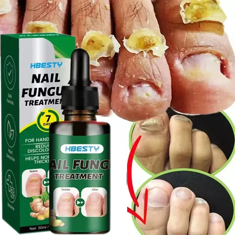 

7Days Nail Fungus Treatment Serum Ginger Anti-infective Paronychia Onychomycosis Toe Foot Nail Fungal Repair Gel Hand Foot Care