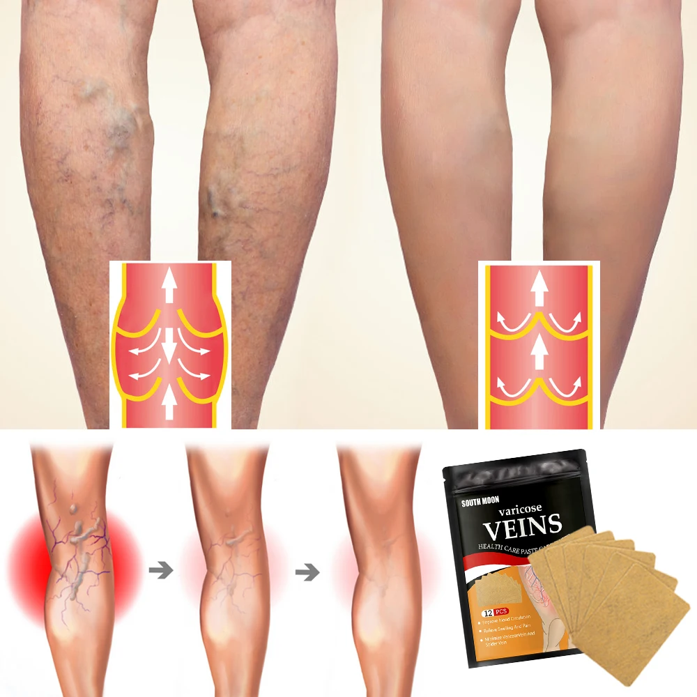 12/24/60pcs Varicose Veins Relief Patch Thigh Leg Pain Spider Removal Phlebitis Plaster Feet Anti Swelling for Foot Health Care