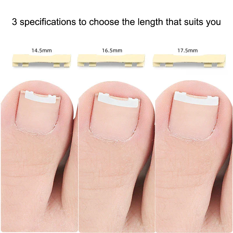 Corrector de uñas encarnadas, herramientas para pedicura, recuperación integrada, tratamiento profesional de uñas encarnadas, cuidado de los pies, 1 Uds.