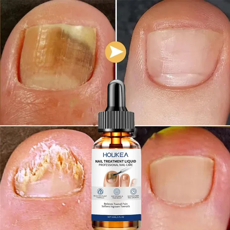 مصل علاج فطريات الأظافر إصلاح القدم السائل تو الأظافر إزالة الفطريات هلام مكافحة العدوى بارونيشيا فطار كريم 30 مللي