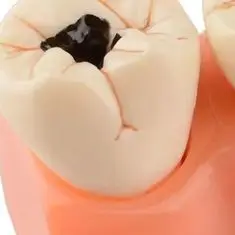 

Denture Caries Disease Tooth Model Decomposition Decay Tooth Model Dental Teaching Tools