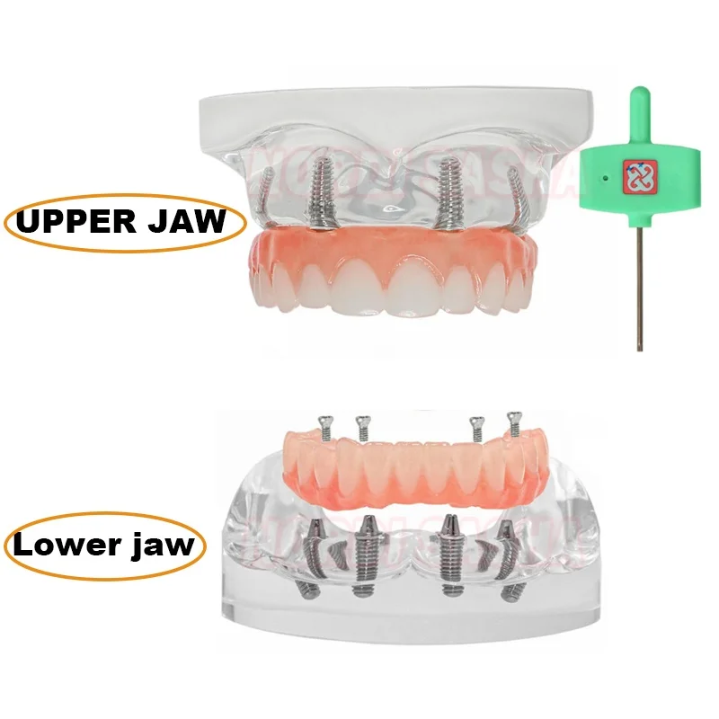 

Transparent Dental Implant Model All On 4 Upper/Lower Jaw Dental Overdenture Teeth Model With Removable Recondition Implants