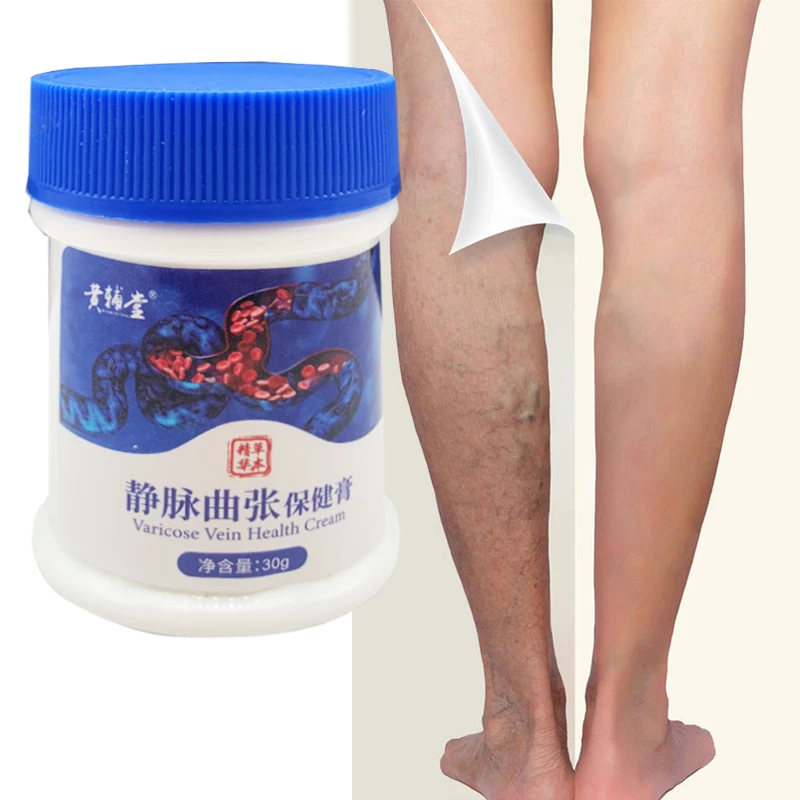 Varicose Veins Treatment Cream Effective cure Varicosity Angiitis ointment Health Care Vasculitis Phlebitis Spider Veins Pain