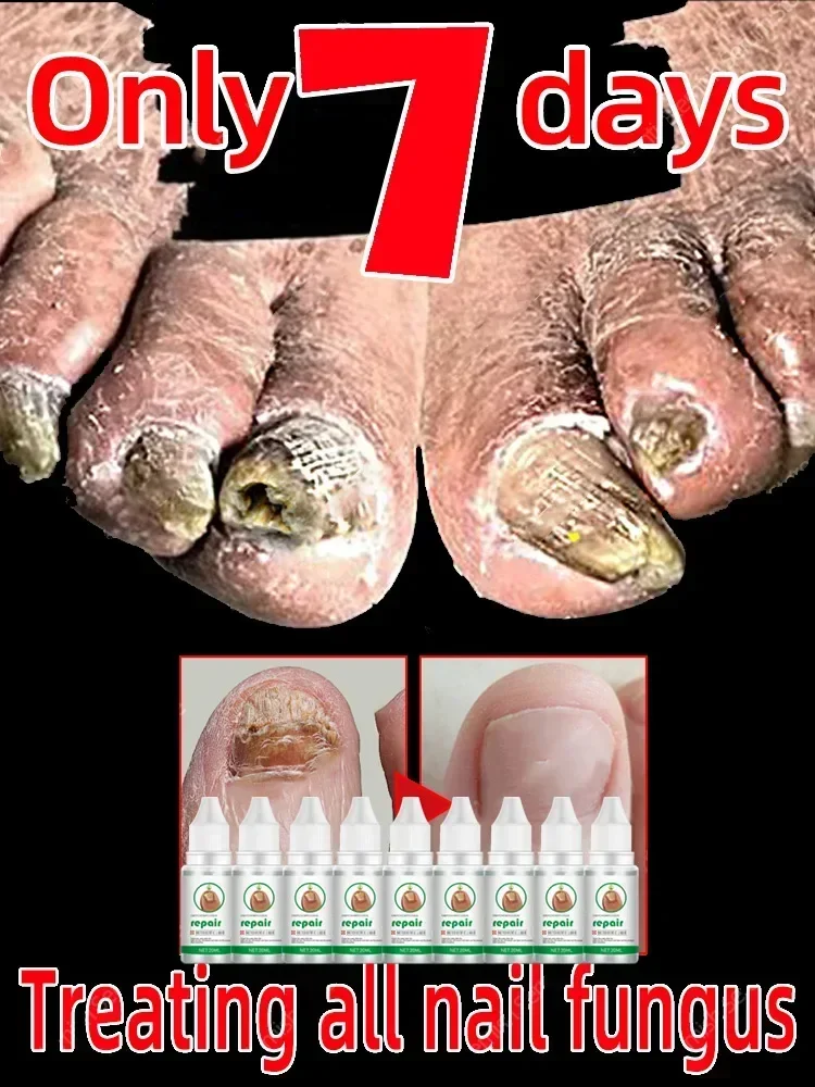 

Nail Fungus Treatment Serum Toe Fungal Repair Products Hand Foot Care Removal Gel Anti Infection Onychomycosis Paronychia