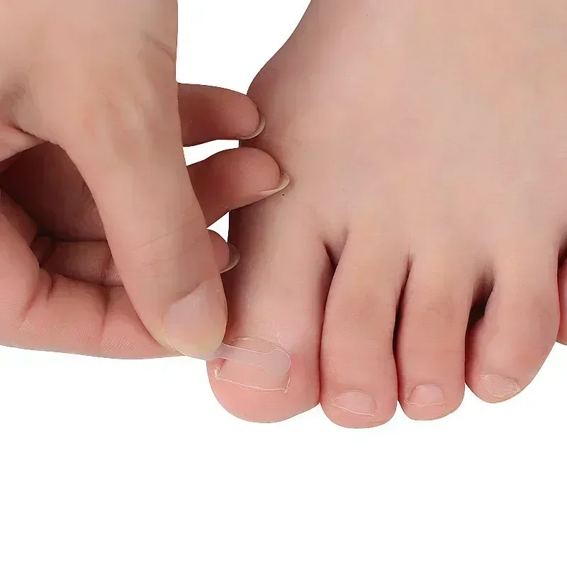 เล็บร่องคุด Toenail Correction อุปกรณ์เล็บ Patch Pull-Up เล็บเท้า Pedicure ชุด Quick ติดแถบ