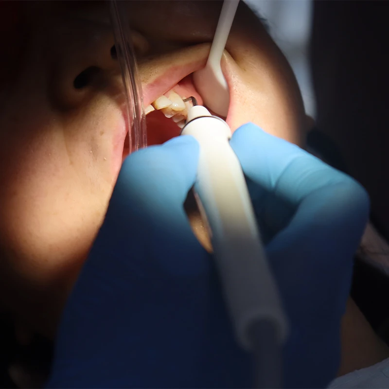 Dentaler Ultraschall-Scaler Handstück, Scaler-Kabel, Silikonschlauch für EMS / Woodpecker Zahnarztmaschinen, Zahnarztstuhl, Mundhygiene – Detail 3