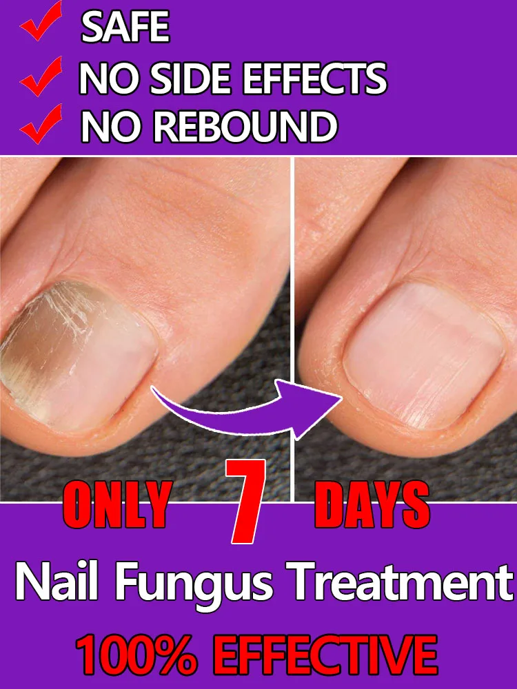 

ᴺᵃⁱˡ ᶠᵘⁿᵍᵘˢ ᵗʳᵉᵃᵗᵐᵉⁿᵗ ᵉˢˢᵉⁿᵗⁱᵃˡ ᵒⁱˡ⸴ ʳᵉᵖᵃⁱʳ ᵒⁿʸᶜʰᵒᵐʸᶜᵒˢⁱˢ ⁱⁿ ⁷ ᵈᵃʸˢ