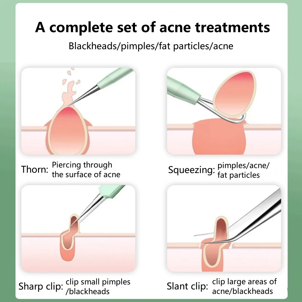 5 pz/set Acne Ago In Acciaio Inox Acne Clip Set Spremere Comedone Brufolo Cellule Acne Ago Bellezza Strumenti Puliti Del Viso