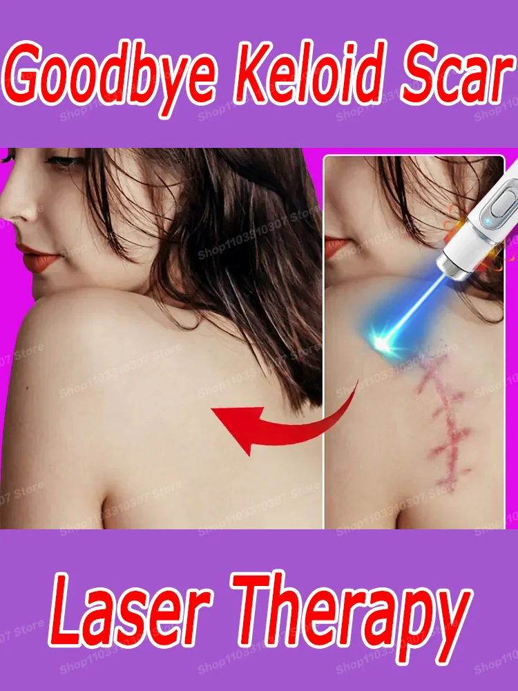 

Laser therapy Keloid Scar