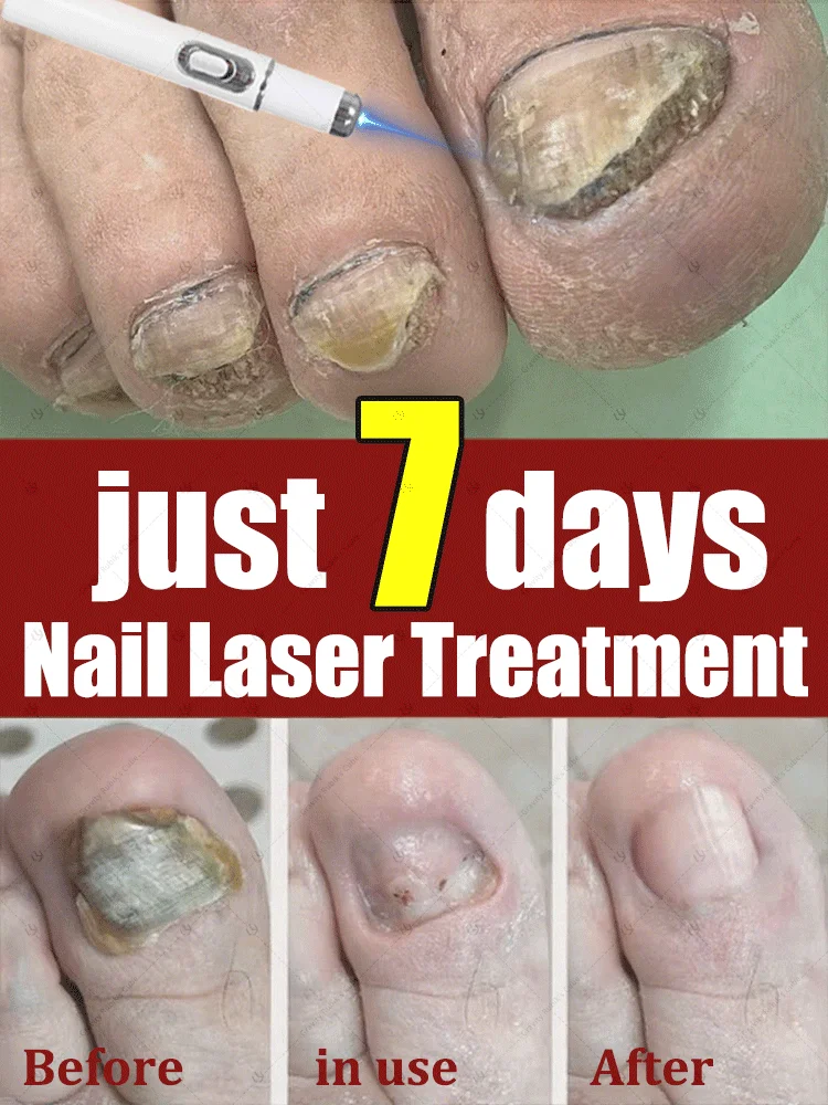 

Blue laser care manicure，25 hot selling nursing tools