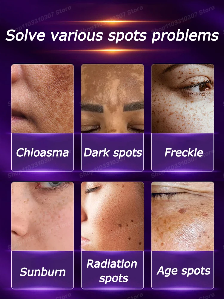 Whitening Freckles Cream Melasma Dark Spots Fade Pigmentation Moisturize Brighten Face Skin Care