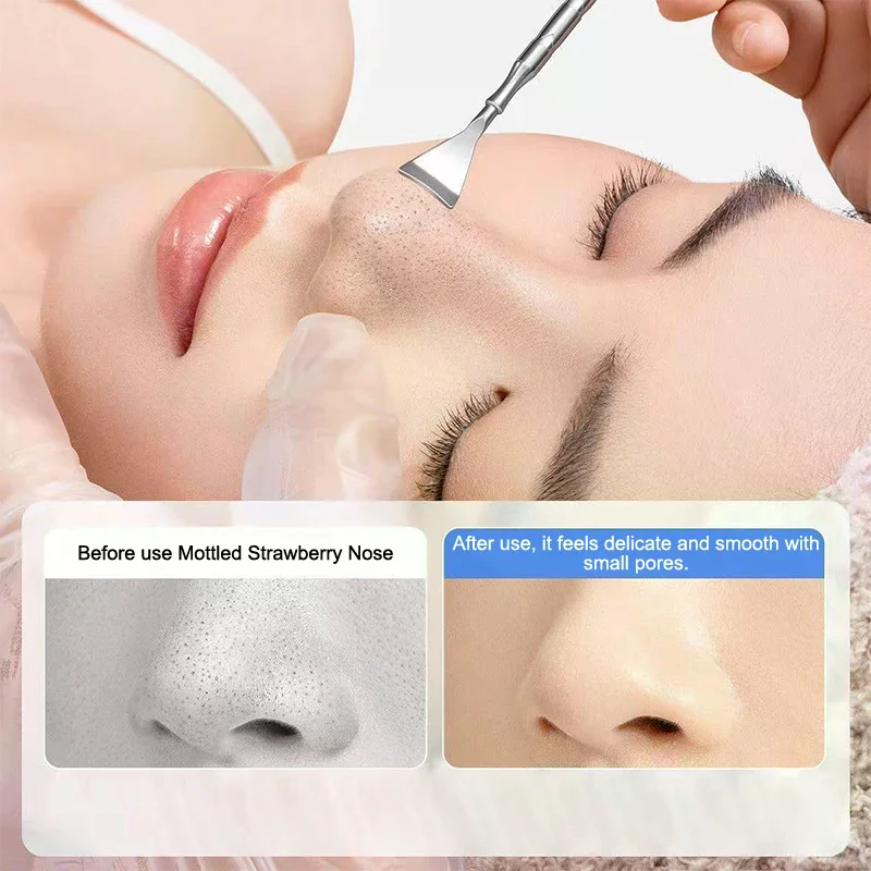 Blackhead Acne Remover Pimple Popper Tool Acne Needle Removing Hair Follicle Cleaning Whitehead Nose Face Blemish Extractor