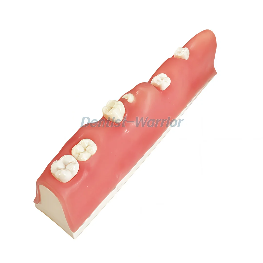 Unerupted Impacted Tooth Extraction Model Dental Practice Wisdom Training Model Practice