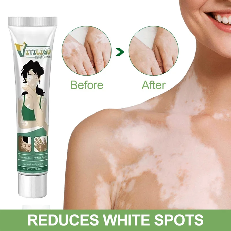 

Vitiligo Cream Natural Relief Skin Treatment Soothing White Spot Removal Vitiligo Cream Eliminate Pigment removes white patches