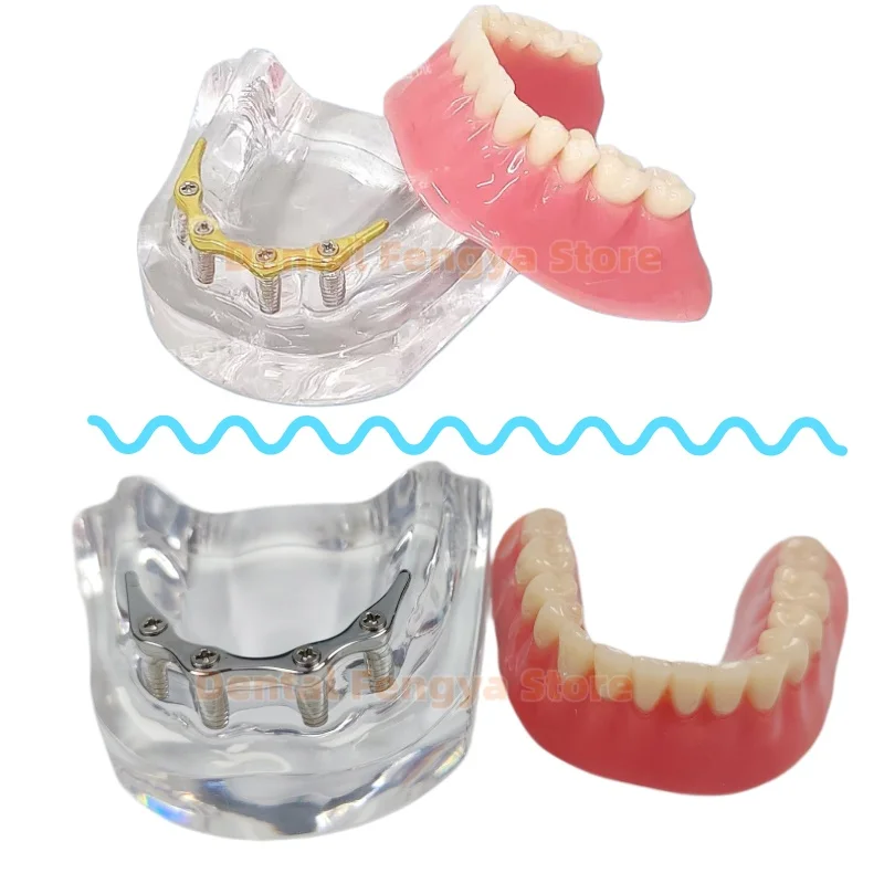 1 Pcs Dental With 4 Implants Overdenture Restoration Teeth Model With Silver/Gold Connecting Rod Dentist Teaching Demo Typodont
