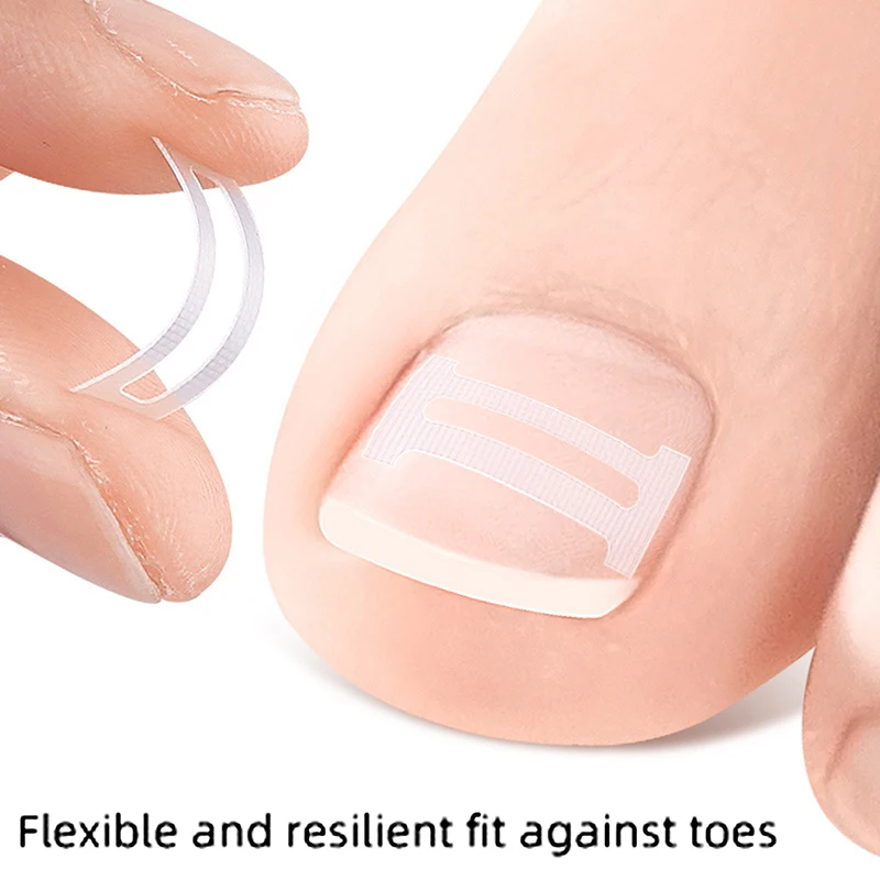 10 pcs Alien Ingrown Toenail Corrective Clip Strips Nail Treatment Elastic Corrective Clip Bracket Foot Care Tools