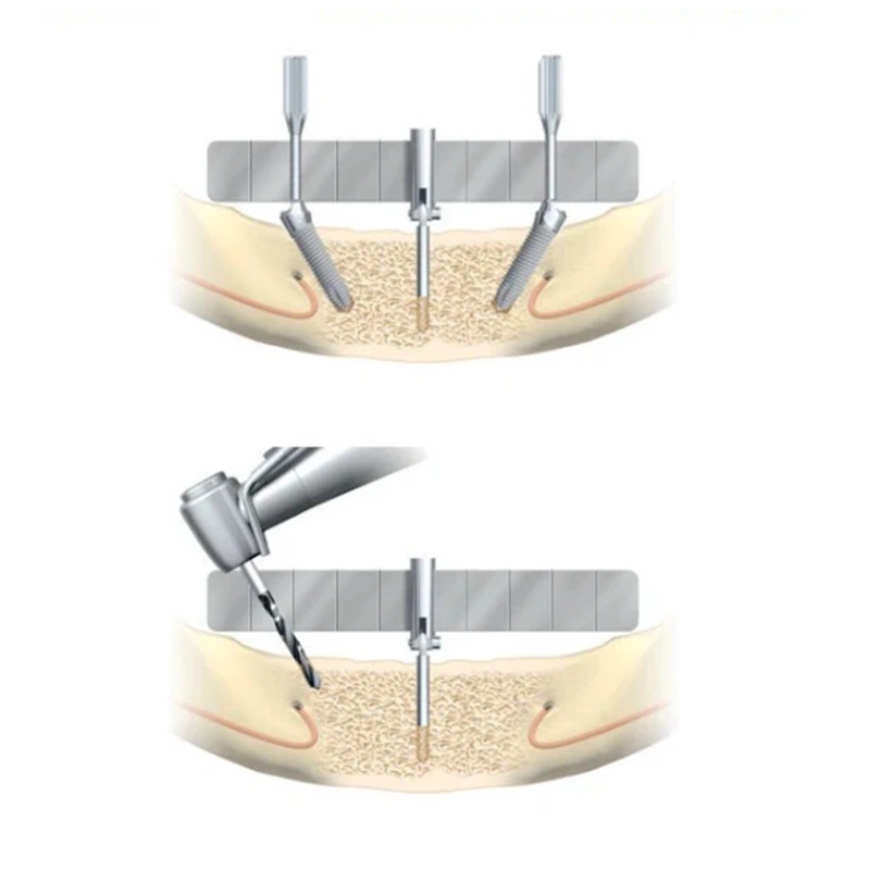 

Dental Implant Locating Guide Surgical Planting Positioning Locator Angle Ruler Guage Autoclavable With 1 PC Extra Replace Rule