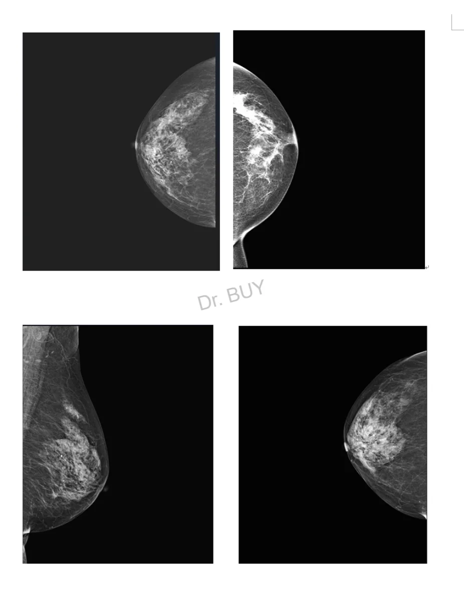 10x12' Digital X-ray Flat Panel Detector- for mammography detector