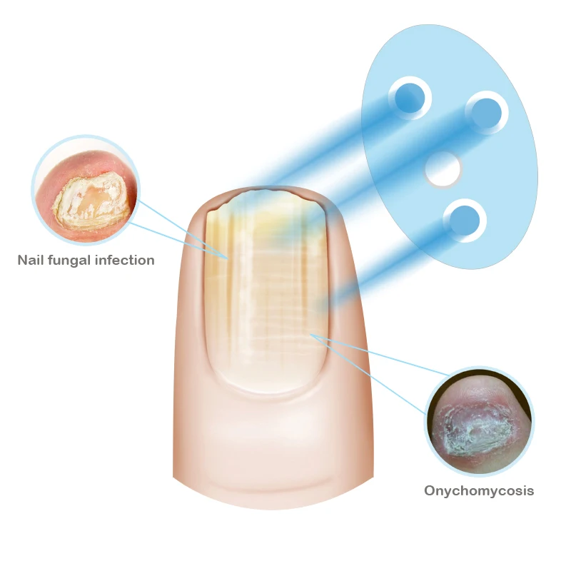 Fingernail Repair Nail Cleaning Lasers Device Nail Fungus Treatment Cold Lasers Therapy Physical Therapy Onychomycosis