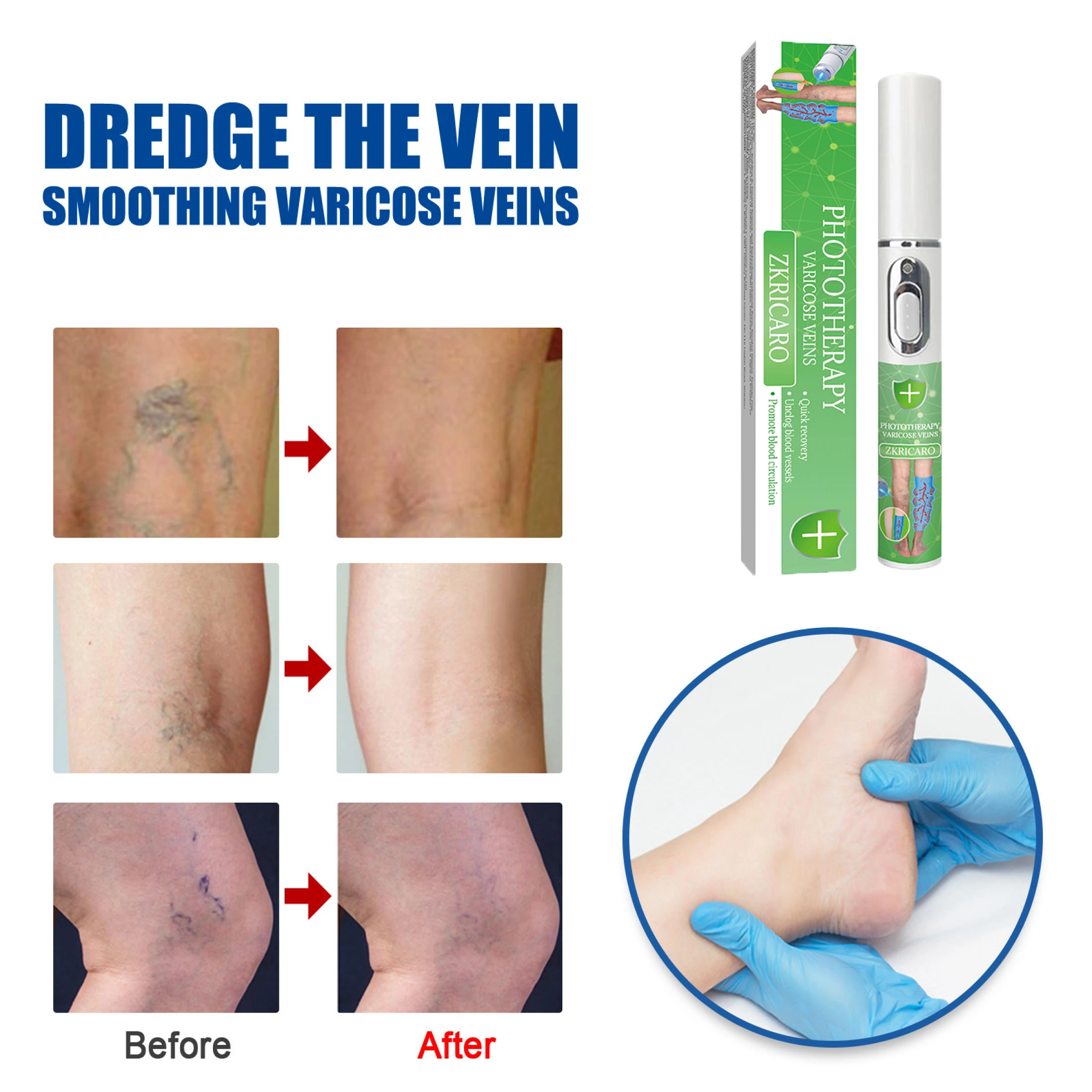 Varicose vein treatment Laser relief for leg problems